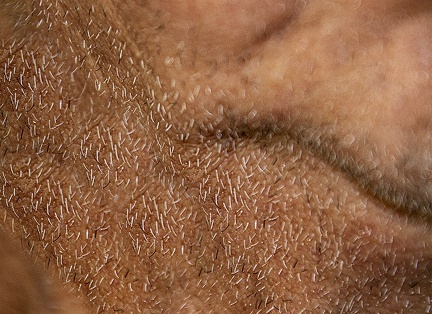 mruppert-Prickly Beard